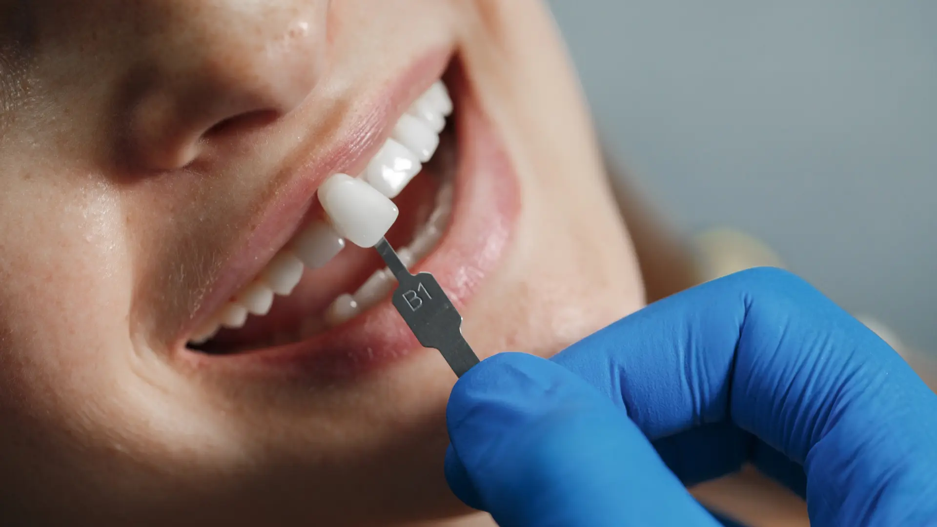 Zirkonyum-dis-kaplamasi-nerede-yaptirilir