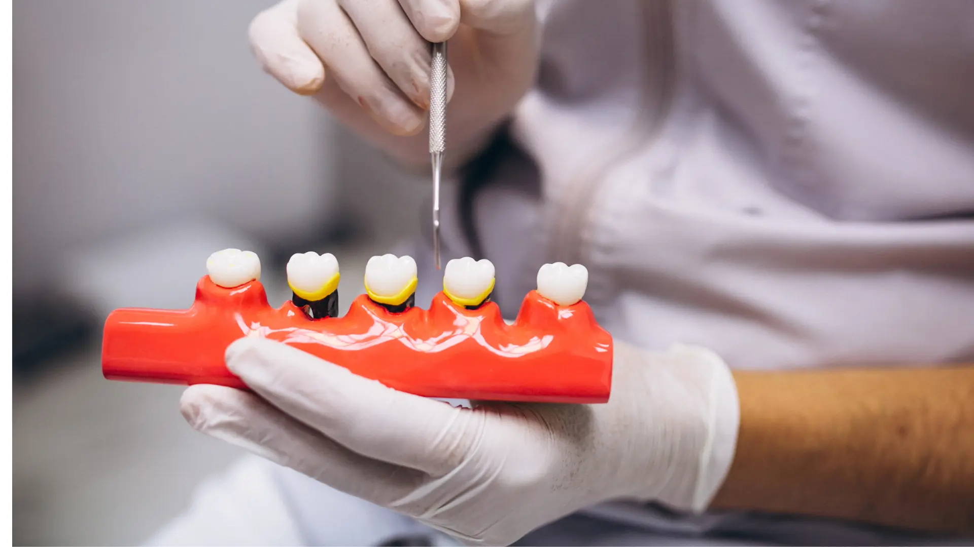 All-on-four-implant-nerede-yaptirilir