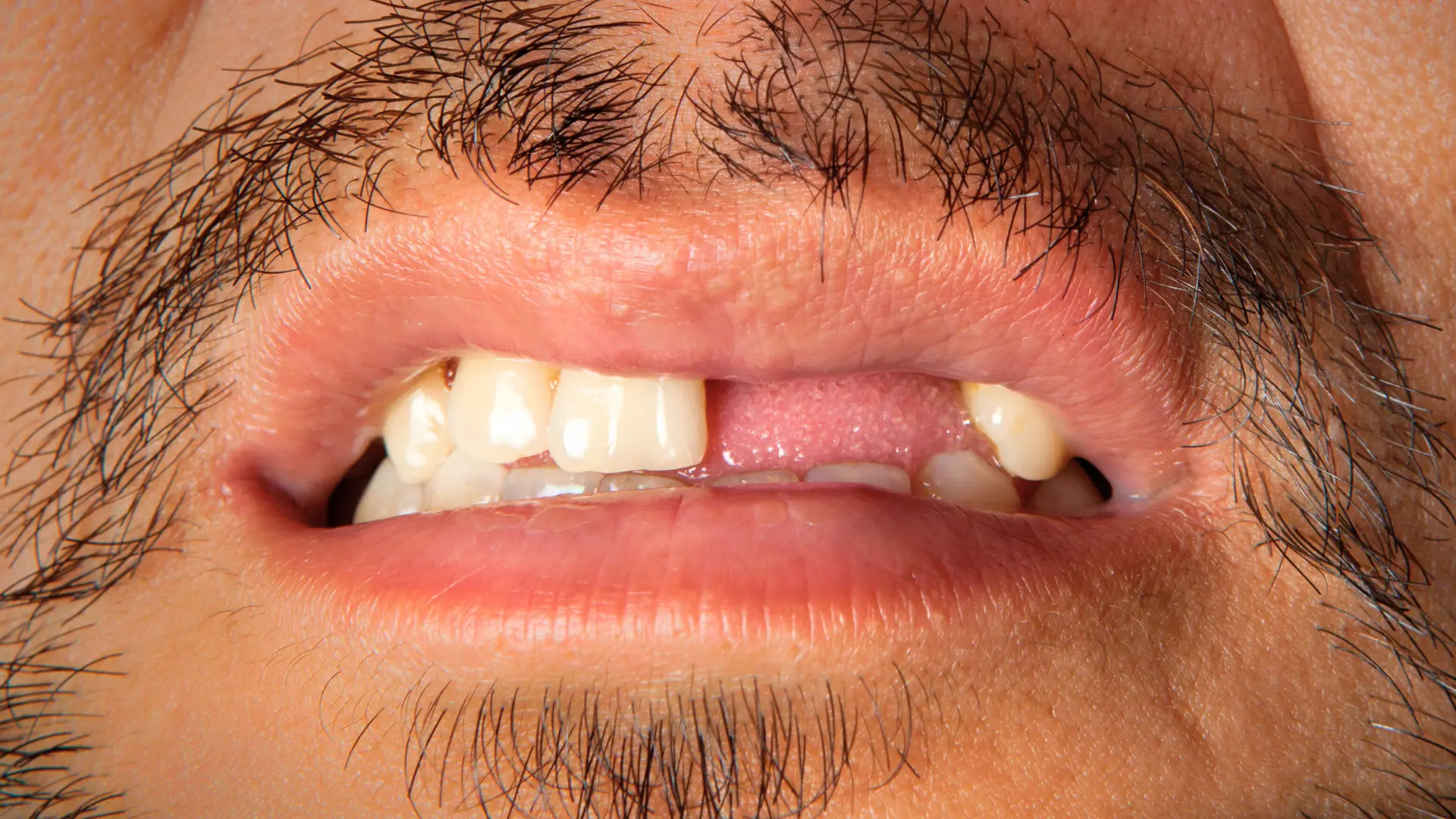 Diş Estetiği İhtiyacı