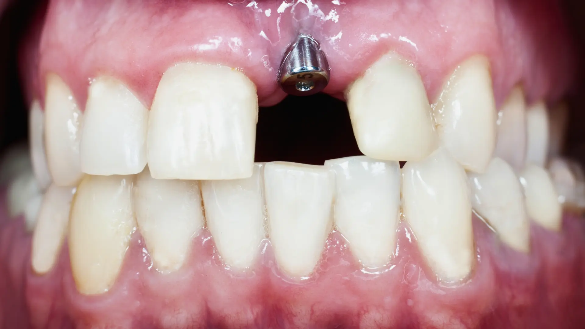 Hangi Durumlarda Diş İmplantı Yapılmalıdır?