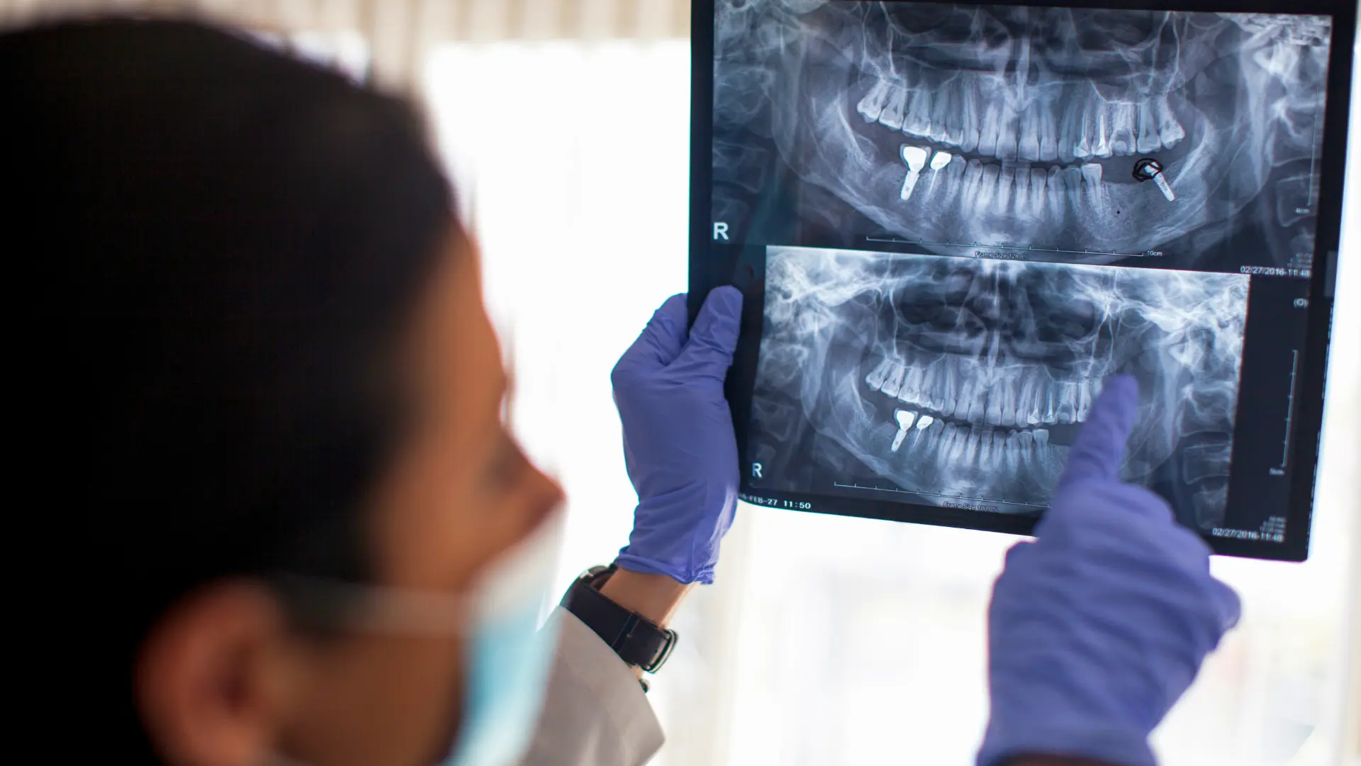 tüm diş implantı hazırlığı