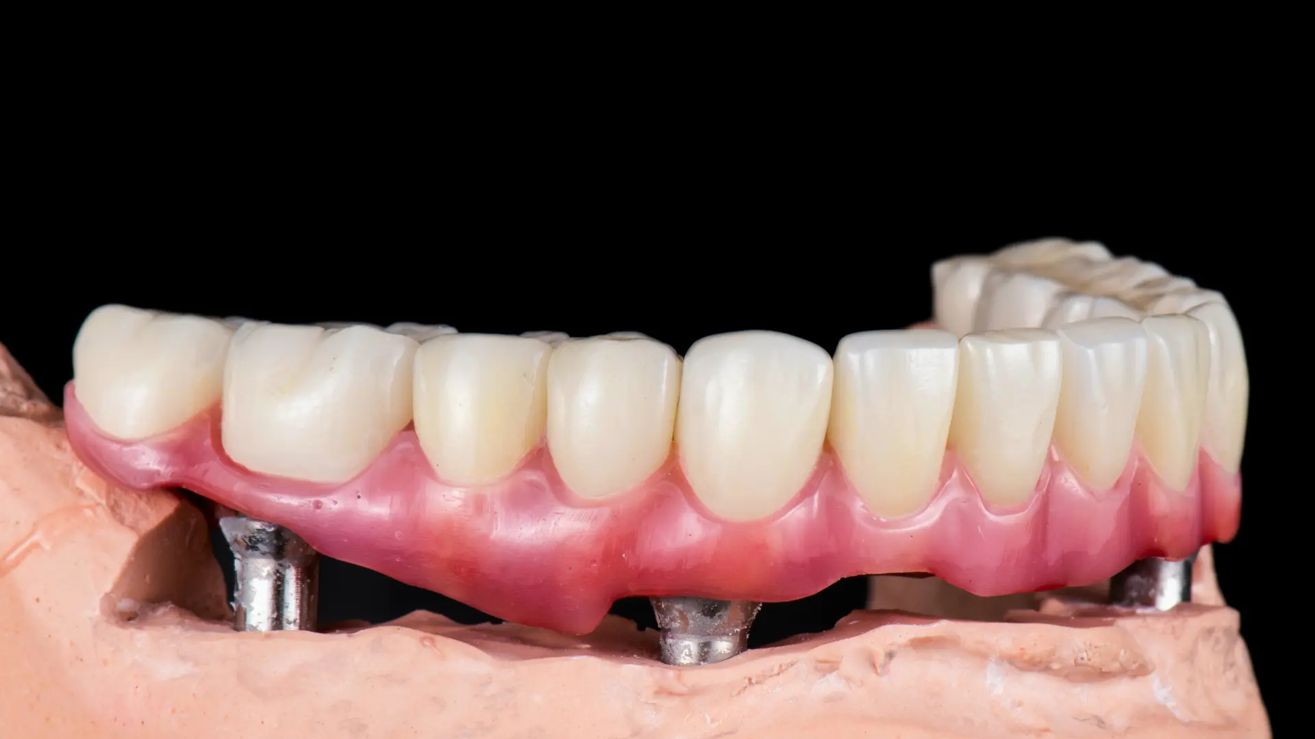 tüm dişlere implant yaptırmak