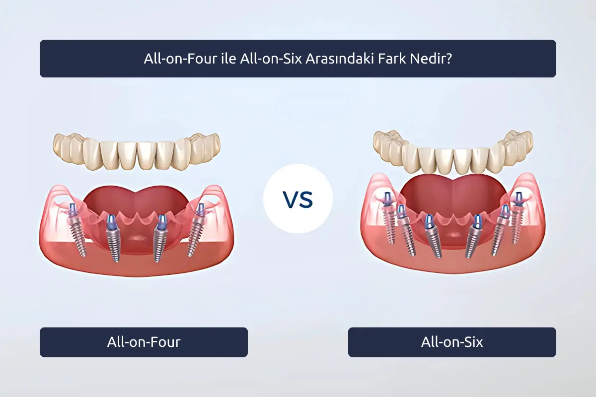 All-on-Four ile All-on-Six Arasındaki Fark Nedir?