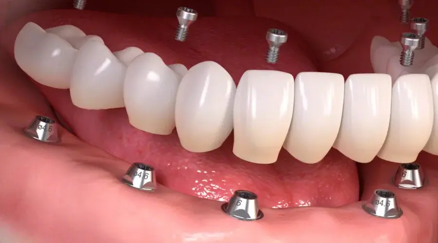 All-on-Six implant tedavisi