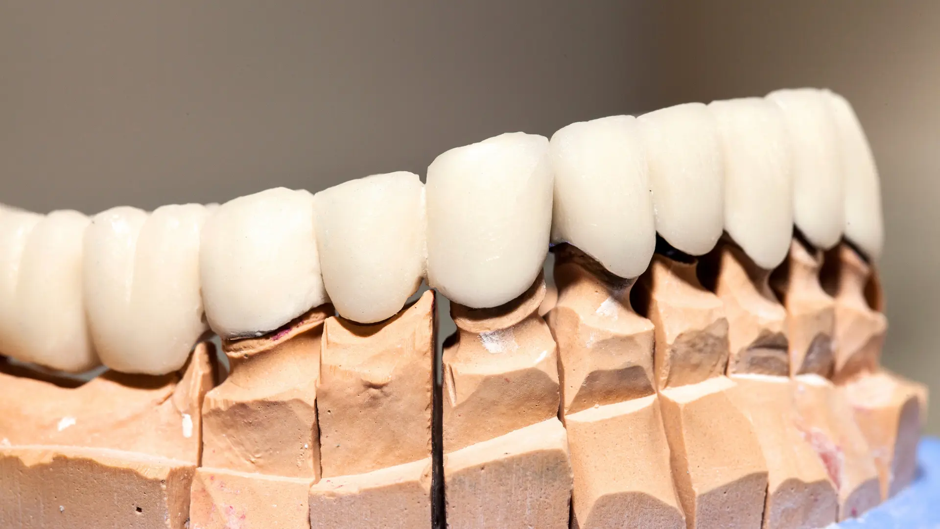 Zirkonyum Kaplama nasıl gözükür