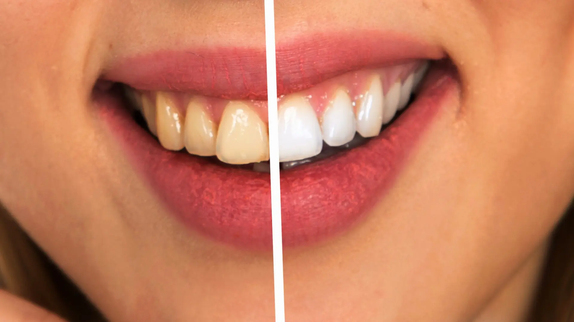 zirkonyum diş kaplama öncesi ve sonrası