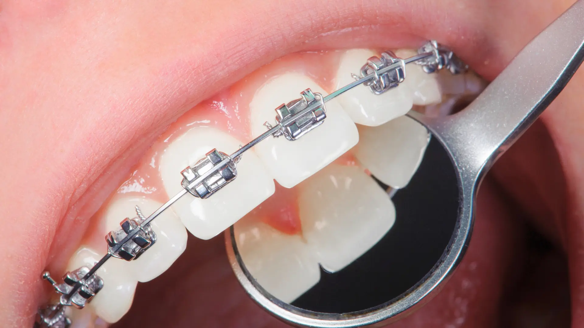 diş teli nasıl gözükür